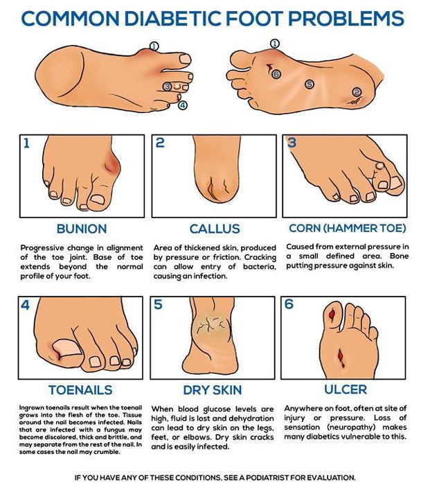 What are the signs of diabetic feet? - Quora